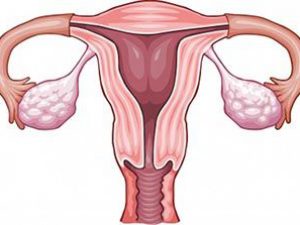 Pelvic-Inflammatory-Disease-Treatment