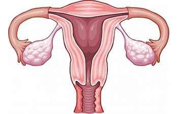 Pelvic-Inflammatory-Disease-Treatment