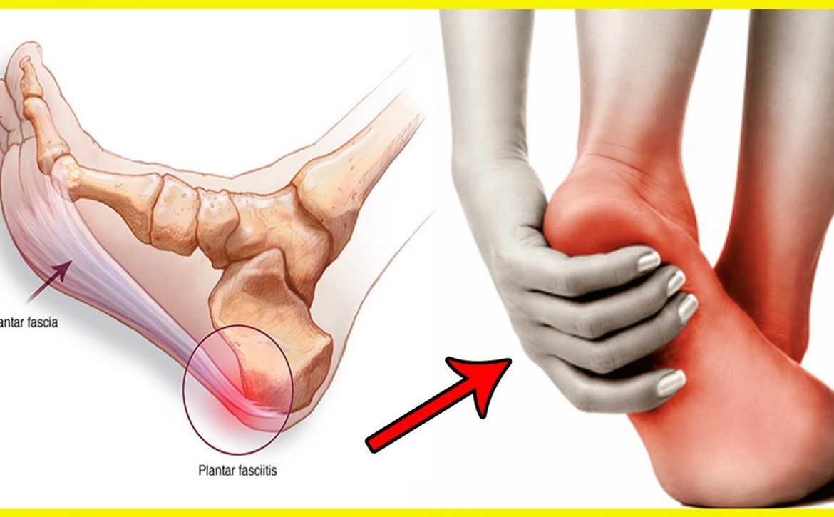 Plantar-Fasciitis