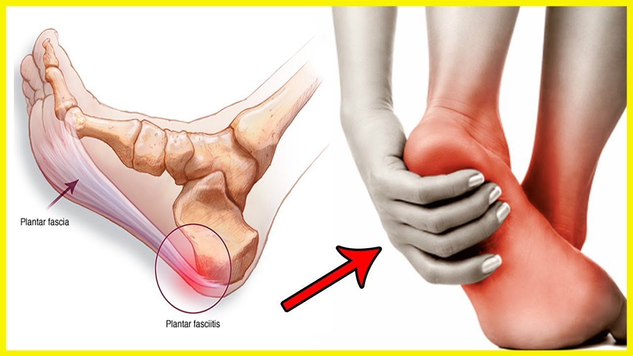 Plantar-Fasciitis
