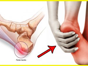 Plantar-Fasciitis