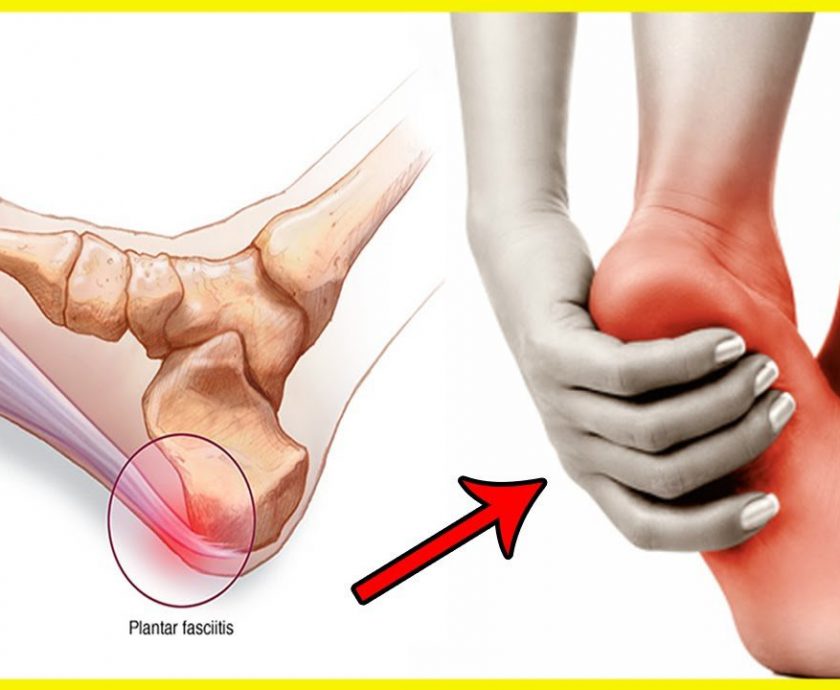 Plantar-Fasciitis
